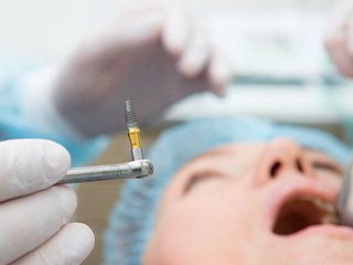 A dental implant surgery