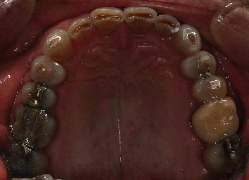top teeth before