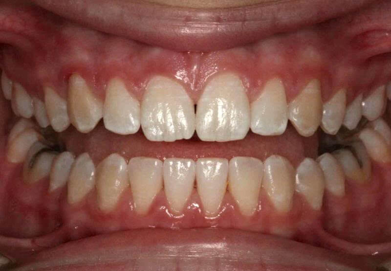 case three teeth after