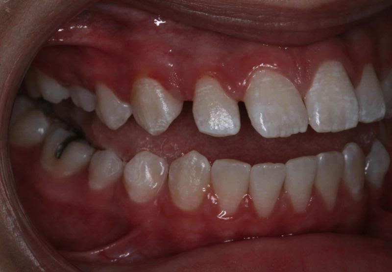 case three teeth before
