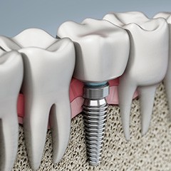 Illustration of dental implant bonded with jawbone