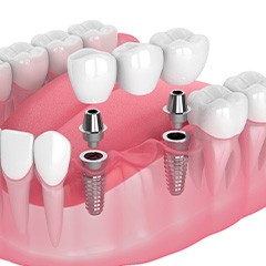 Illustration of dental bridge being attached to dental implants in lower arch