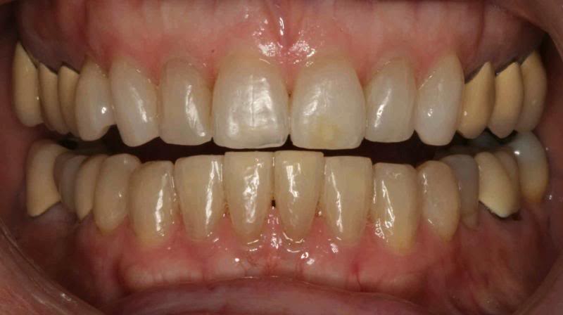 case 5 teeth before