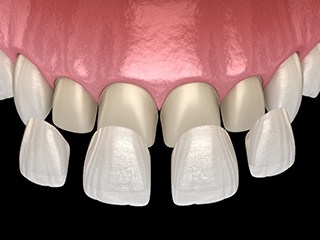 Veneers in Ponte Vedra Beach