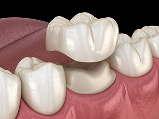 Dental crown in Ponte Vedra Beach