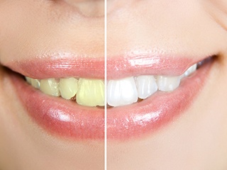 Before and after teeth whitening in Ponte Vedra Beach