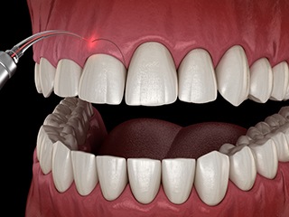 Gum recontouring in Ponte Vedra Beach