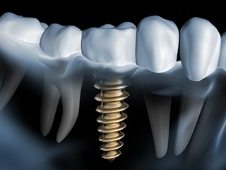 X-ray diagram of dental implants in Ponte Vedra