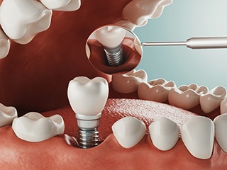 3D illustration showing how dental implants in Ponte Vedra Beach work