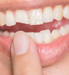 Photograph of a badly chipped tooth