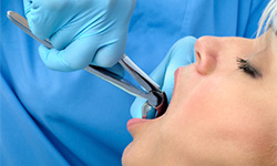 Closeup of patient during tooth removal