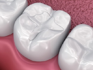 white dental filling