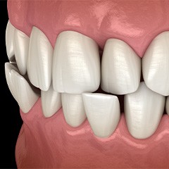 Illustration of a crossbite