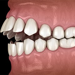 Illustration of an open bite