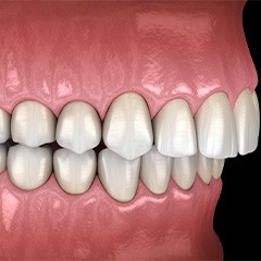 Illustration of an overbite