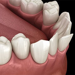 Illustration of crowded teeth