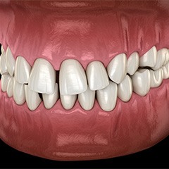 Illustration of gapped teeth