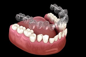 Illustration of Invisalign aligner being placed on crooked teeth