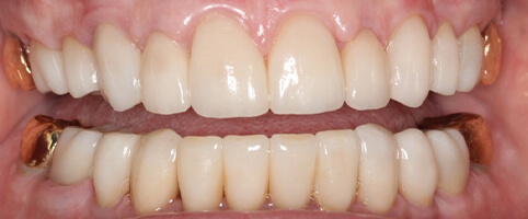 A beautiful smile after cosmetic work