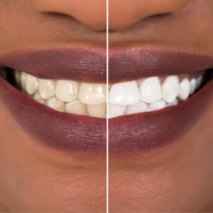 Patient's smile before and after teeth whitening