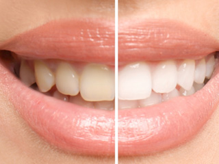 Closeup of patient's teeth before and after whitening