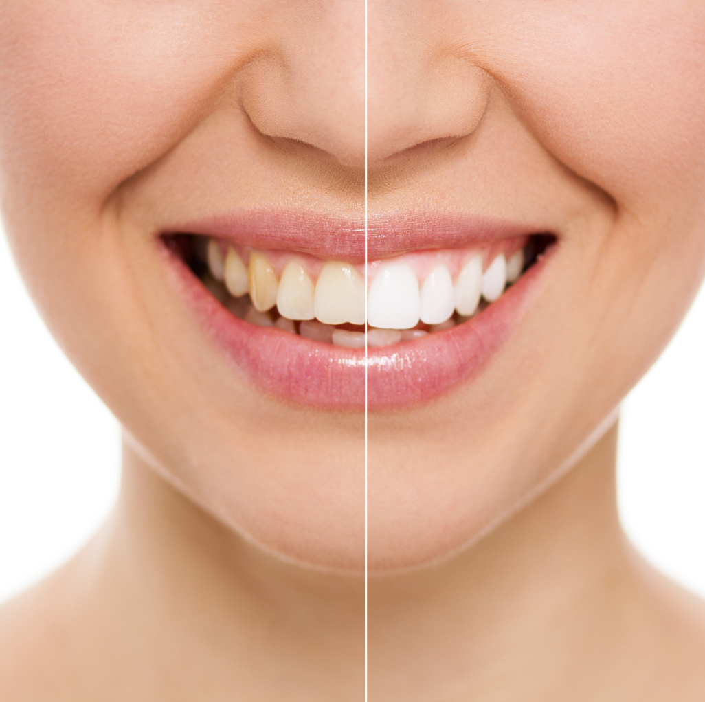 How Do You Get Rid of Teeth Stains and Discolorations? Ponte Vedra