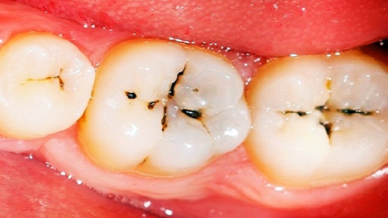Tooth Cavities