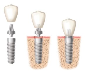 dental implant