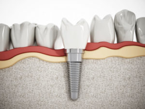 dental implant illustration