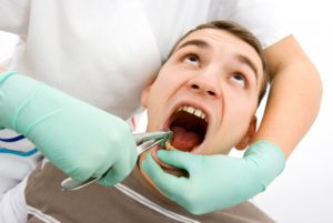 tooth extraction