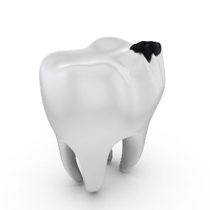 Model of a tooth with a cavity