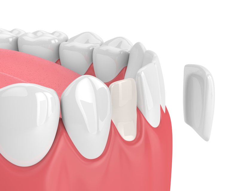 A diagram of a porcelain veneer.