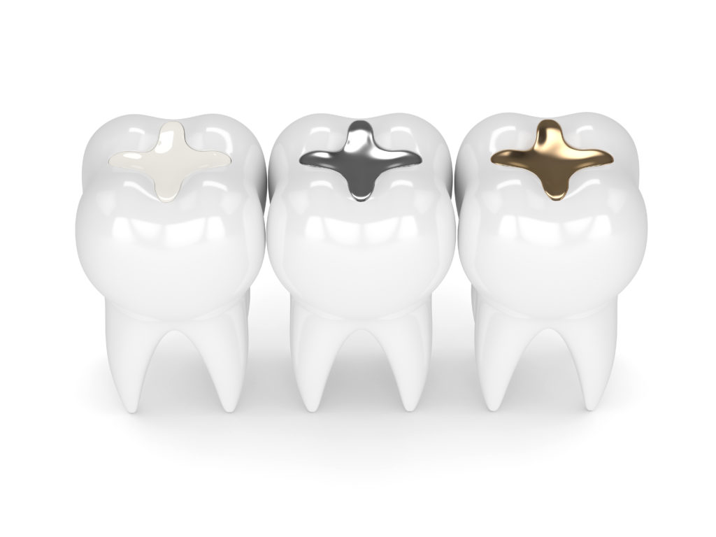 White, silver, and gold dental fillings