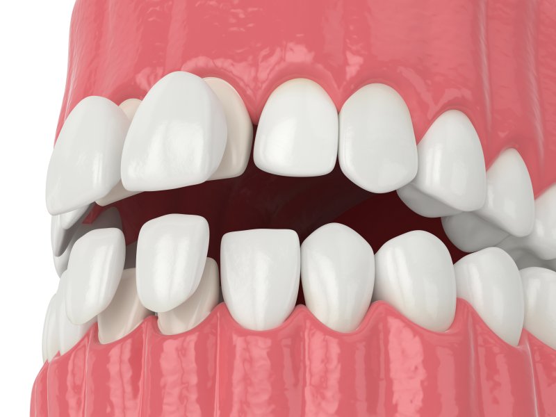 Porcelain Veneers