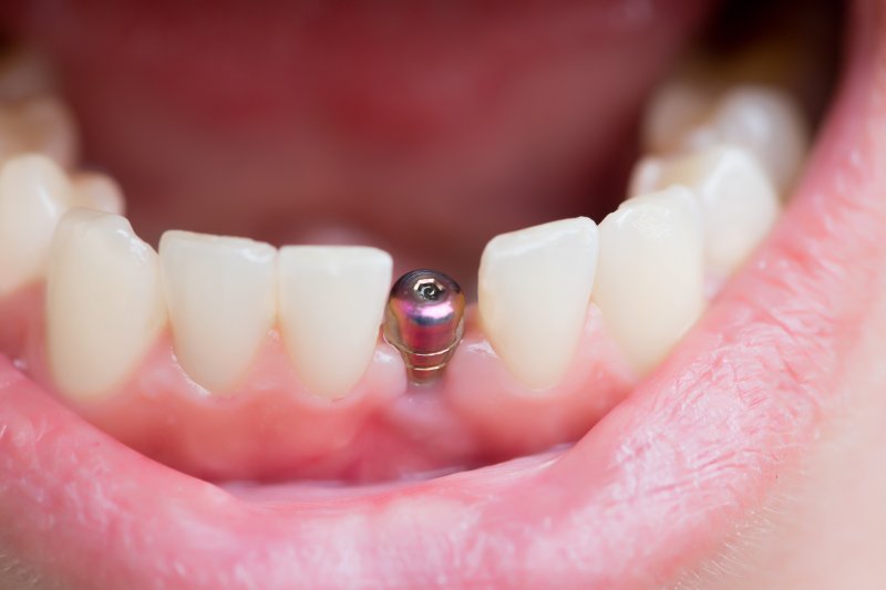 Dental implant in mouth