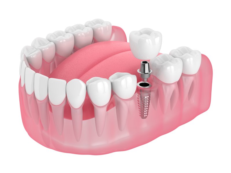 Computer generated model of implant replacing tooth