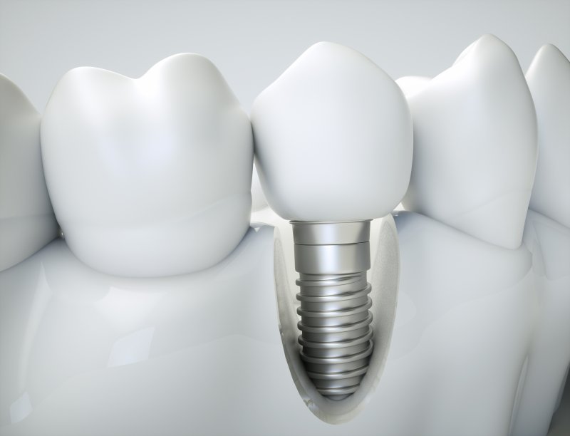 example of dental implants in Ponte Vedra Beach