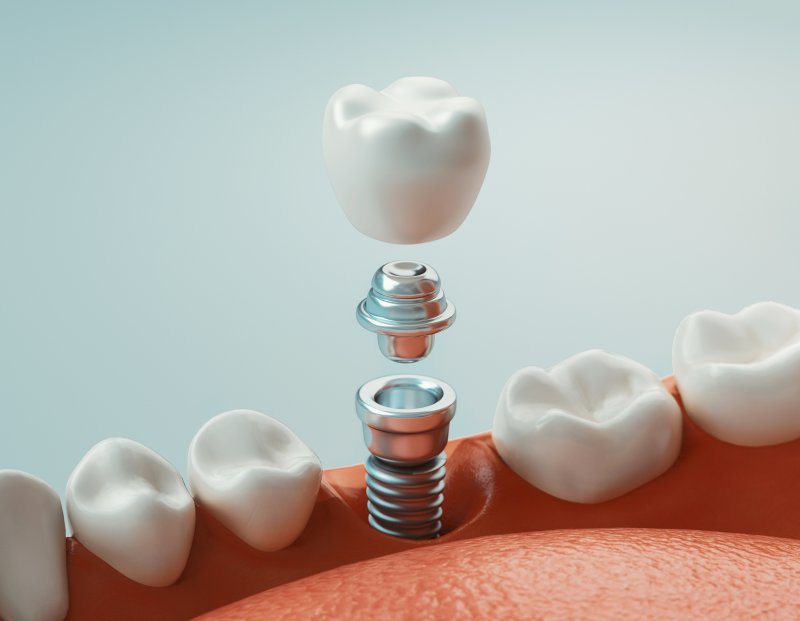 A 3D rendering of dental implant parts