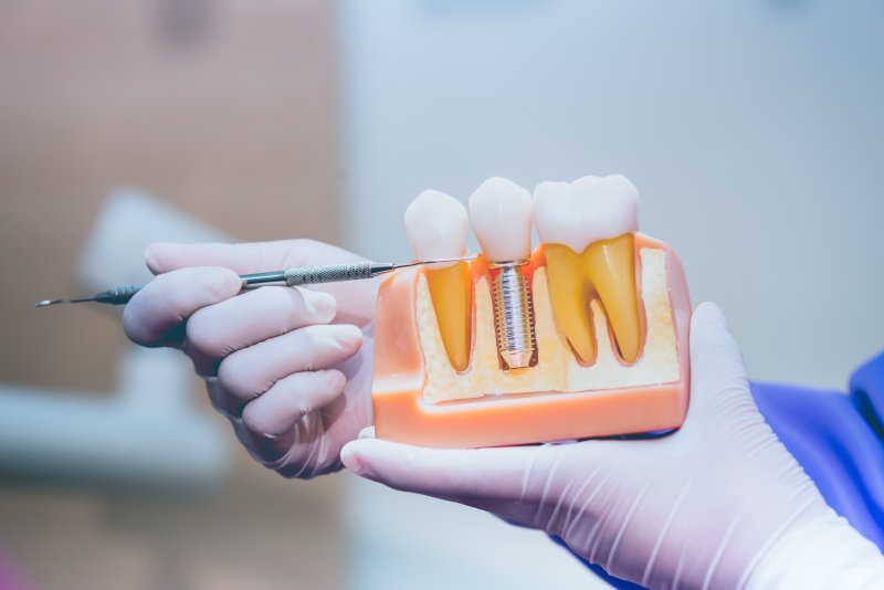 A dentist holding an enlarged dental implant model with a gloved hand