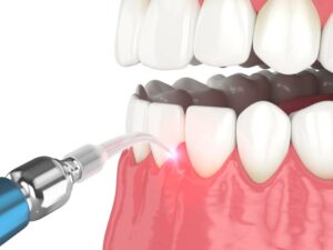 Rendering of gum recontouring treatment. 
