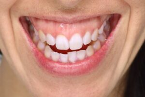 up-close view of a gummy smile
