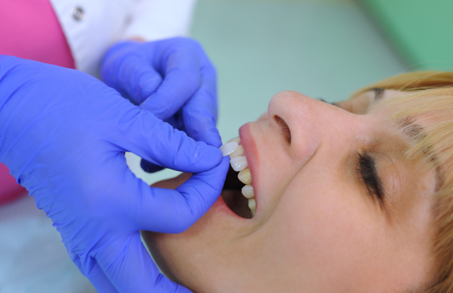 Dentist fitting patient with veneers